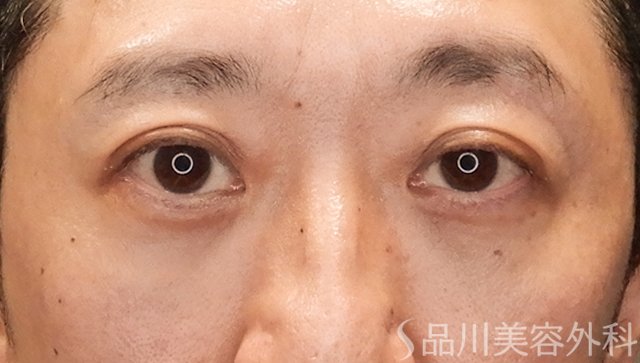 症例NO.75058のAFTER写真