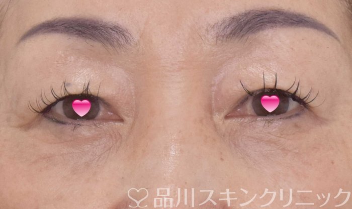 症例NO.69172のAFTER写真
