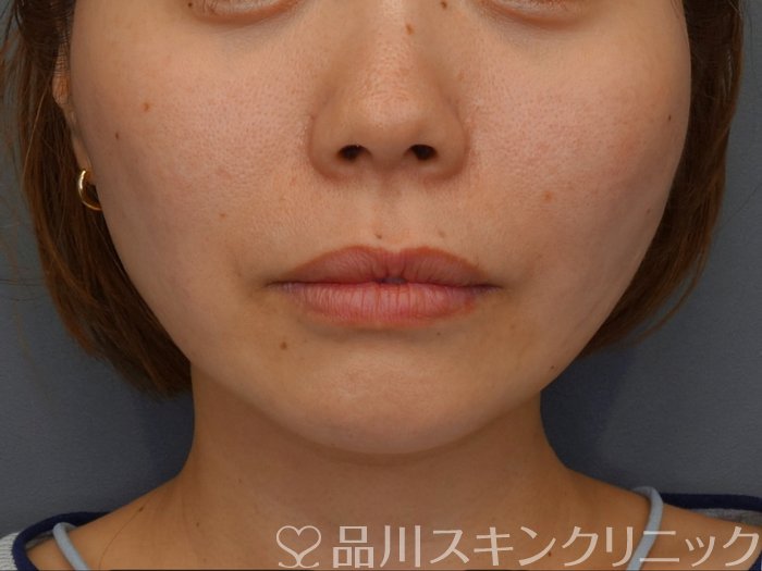症例NO.74898のAFTER写真