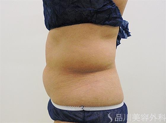 症例NO.22255のBEFORE写真