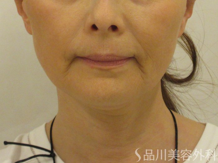 症例NO.74524のBEFORE写真