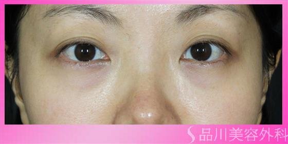 症例NO.53480のBEFORE写真