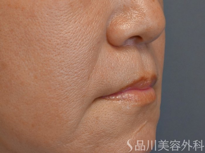 症例NO.71686のBEFORE写真