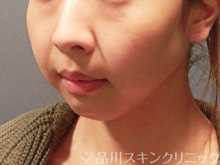 症例NO.63155のBEFORE写真