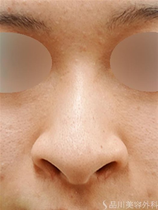 症例NO.33348のBEFORE写真