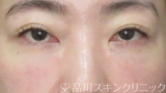 症例NO.72312のAFTER写真