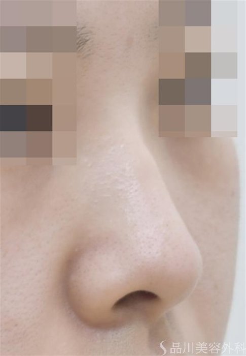 症例NO.46734のBEFORE写真