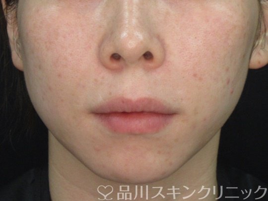 症例NO.74751のBEFORE写真