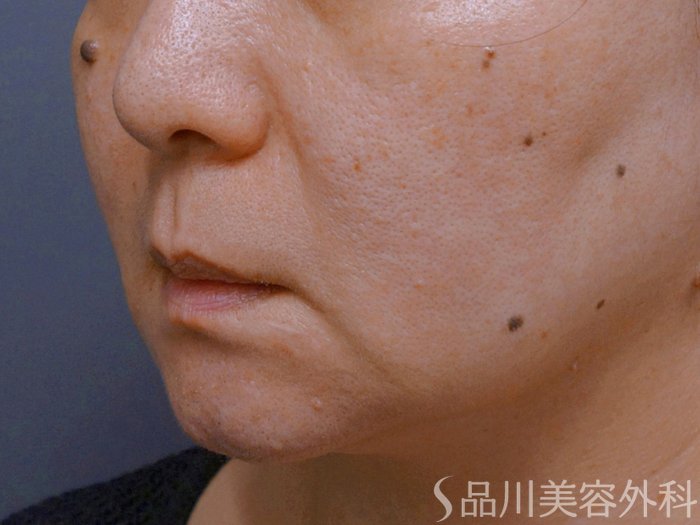 症例NO.74301のBEFORE写真