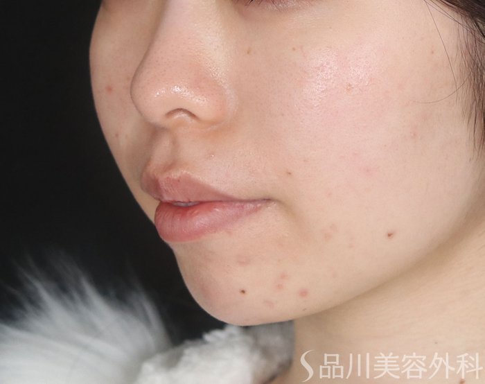 症例NO.73192のBEFORE写真