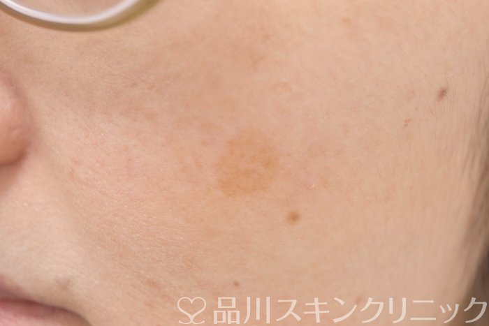 症例NO.70545のBEFORE写真