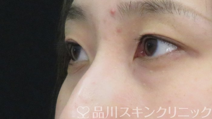 症例NO.72521のBEFORE写真