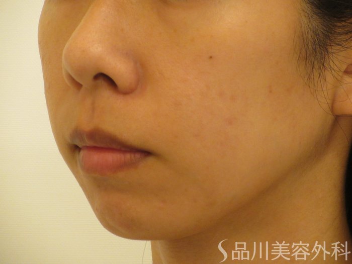 症例NO.71466のBEFORE写真