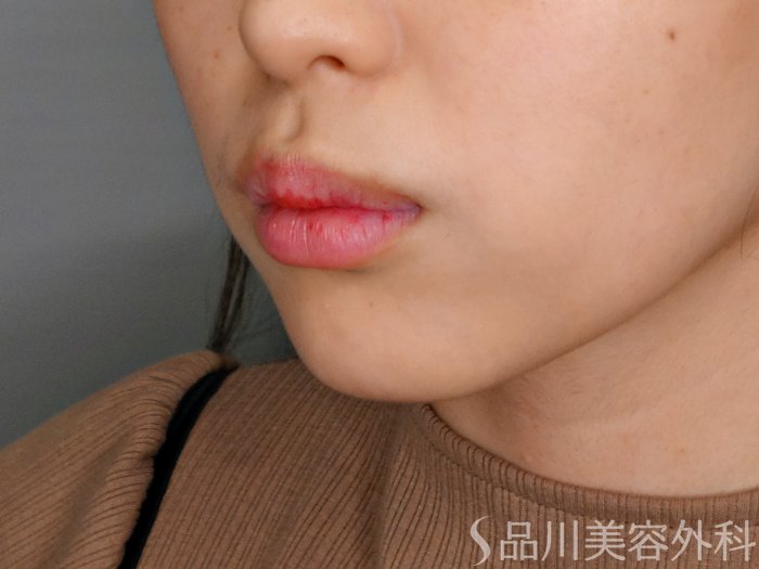 症例NO.69950のBEFORE写真