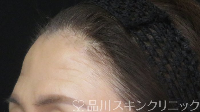 症例NO.70773のBEFORE写真