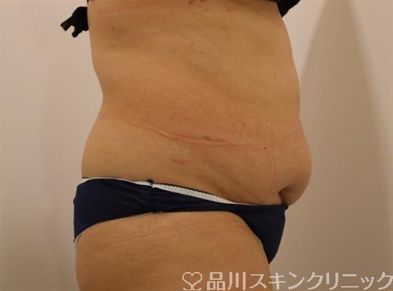 症例NO.42499のBEFORE写真
