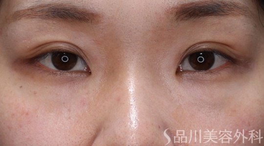 症例NO.69599のAFTER写真