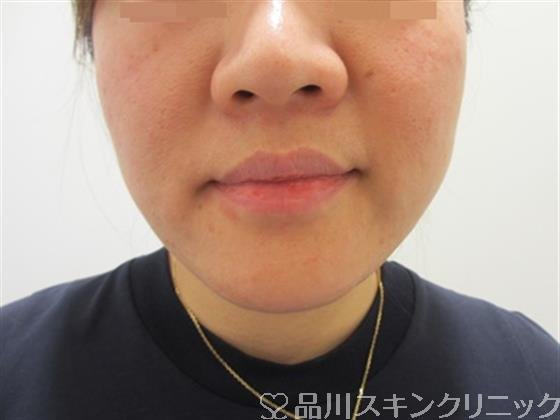 症例NO.38667のBEFORE写真