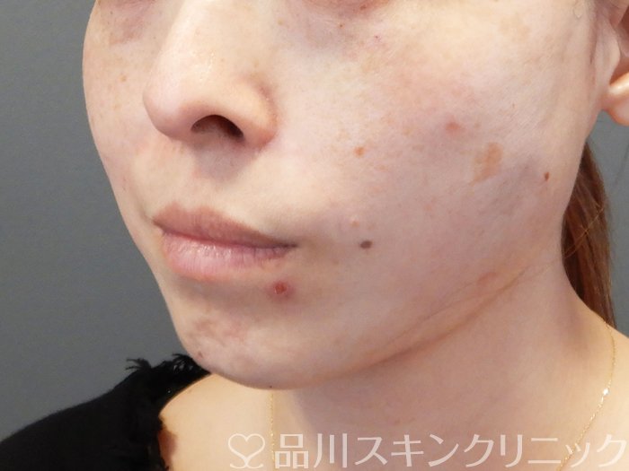 症例NO.72769のAFTER写真