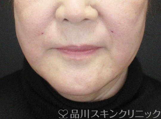 症例NO.69689のAFTER写真