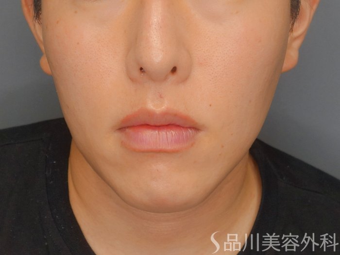 症例NO.73127のAFTER写真