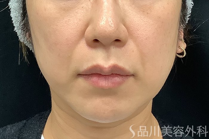 症例NO.73312のBEFORE写真