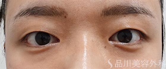 症例NO.54017のBEFORE写真