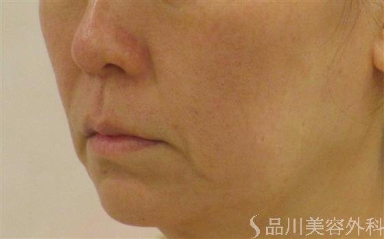 症例NO.55087のBEFORE写真