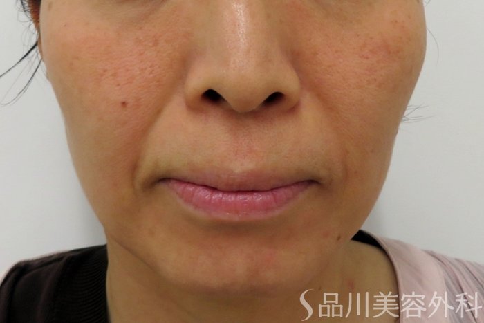 症例NO.74837のBEFORE写真