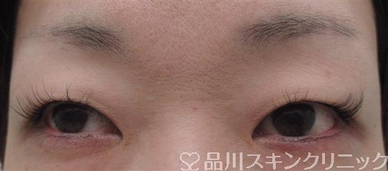 症例NO.26760のBEFORE写真