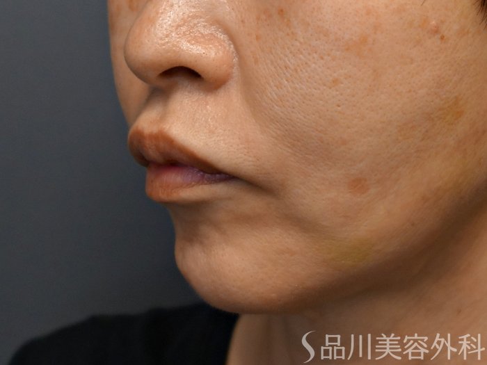 症例NO.71442のBEFORE写真