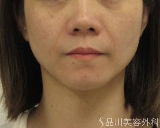 症例NO.75155のBEFORE写真