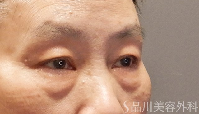 症例NO.74810のBEFORE写真