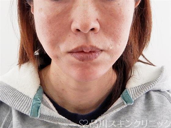 症例NO.58716のAFTER写真