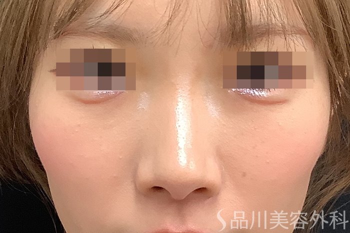 症例NO.71637のBEFORE写真