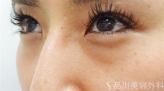 症例NO.39668のBEFORE写真