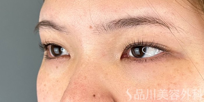 症例NO.70782のBEFORE写真