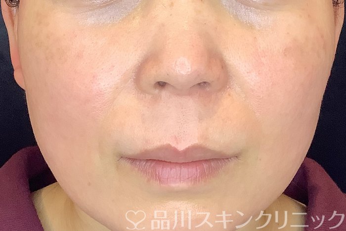 症例NO.64802のAFTER写真