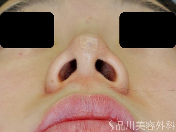症例NO.71152のAFTER写真