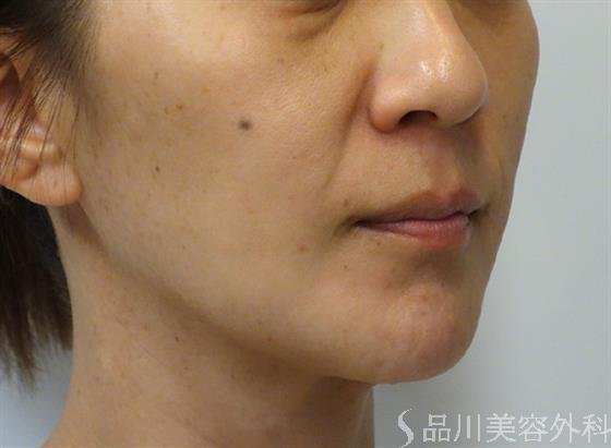 症例NO.39987のBEFORE写真