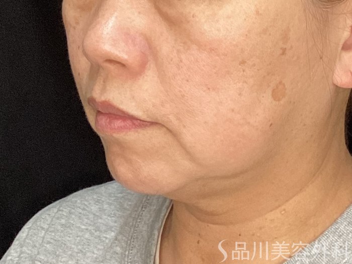 症例NO.72610のBEFORE写真