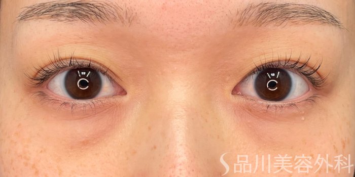症例NO.73568のBEFORE写真