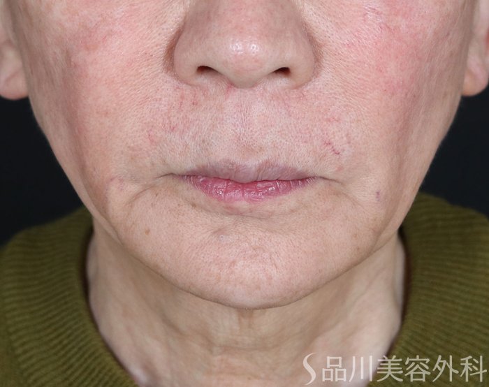 症例NO.73616のBEFORE写真