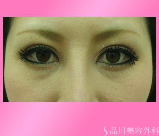 症例NO.14825のAFTER写真