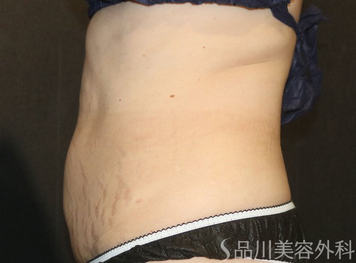 症例NO.72258のAFTER写真