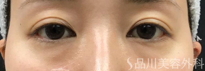 症例NO.69447のBEFORE写真