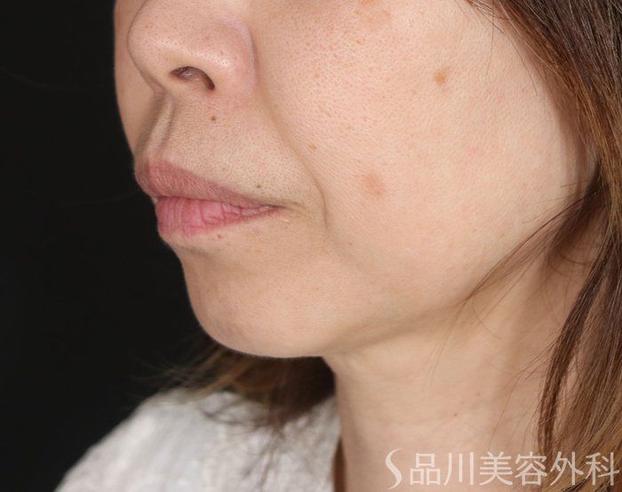 症例NO.72160のBEFORE写真