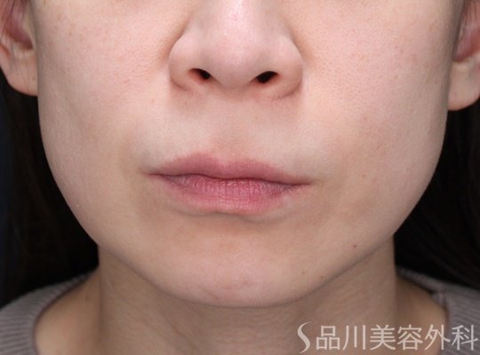 症例NO.69864のBEFORE写真