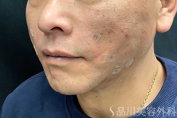 症例NO.69615のAFTER写真