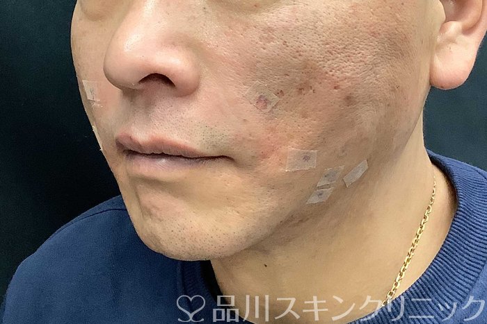 症例NO.69615のAFTER写真